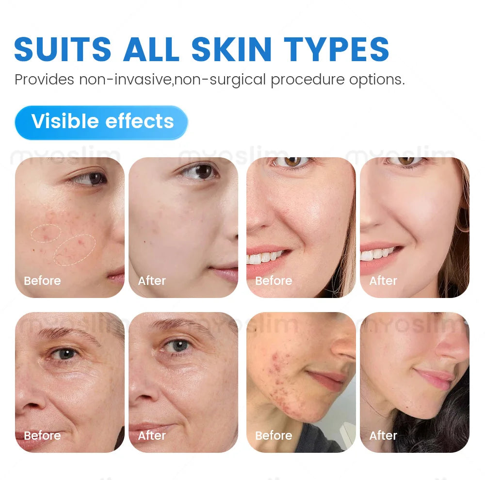 Transform your skincare routine with the 7-in-1 multifunctional beauty machine. Deeply cleanse the skin, remove acne, brighten and whiten, exfoliate, and combat the signs of aging for a revitalized and glowing complexion.