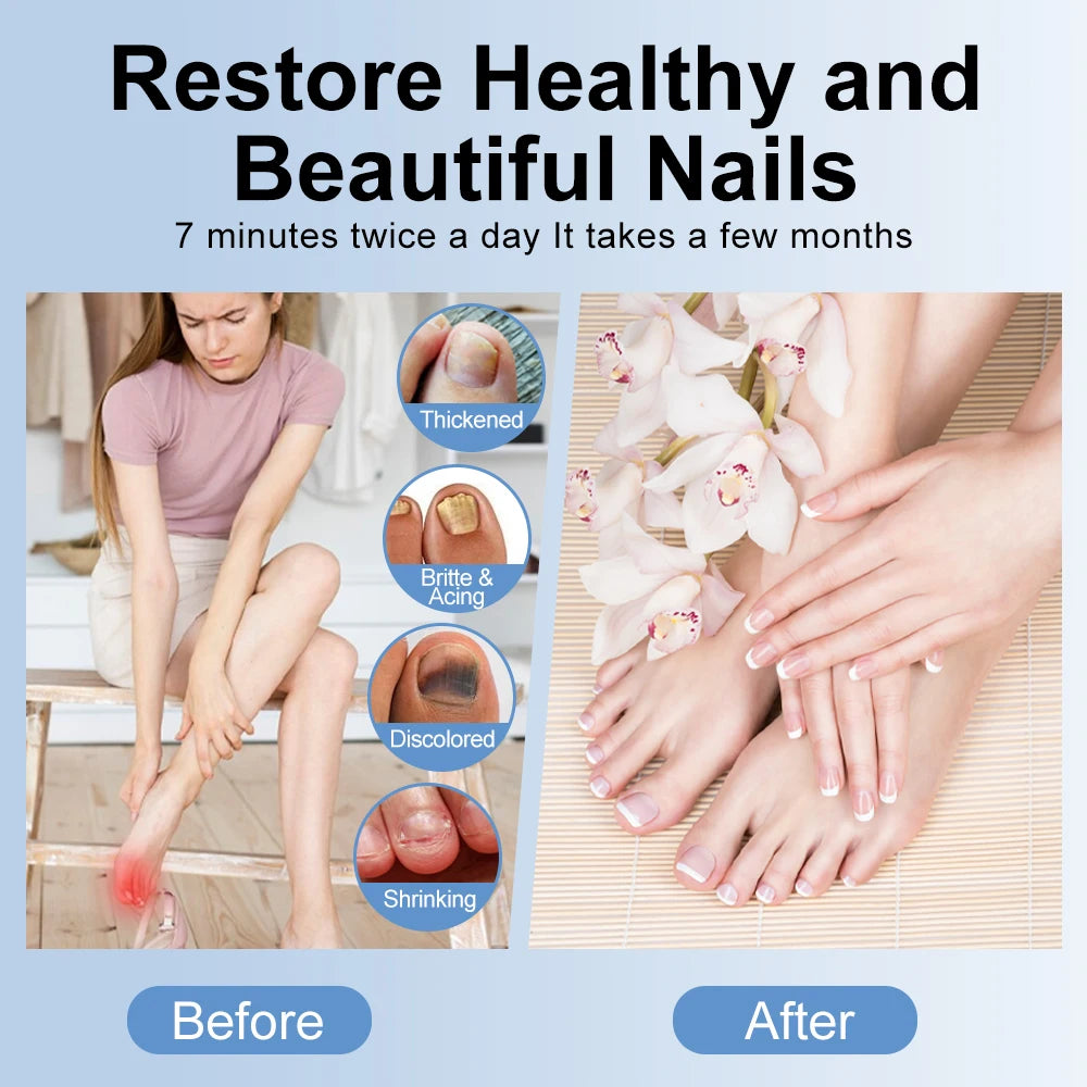 Nails Fungus Laser Treatment Device Rechargeable UV Lamp Fingernails Toenails Onychomycosis Therapy Sterilize Repair Care Tools