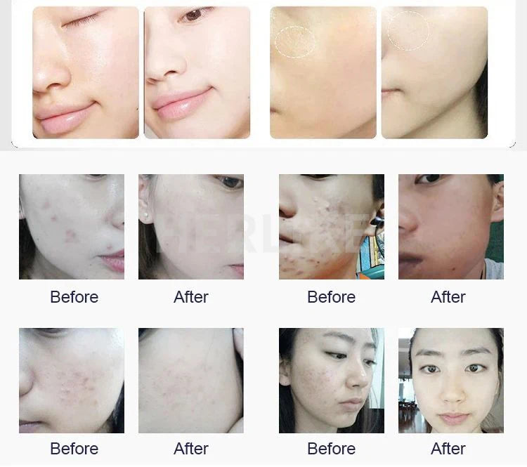 Experience professional skincare with this portable 6-in-1 H2O2 small bubble oxygen facial machine. Improve skin hydration, exfoliate with microdermabrasion, and promote a fresh, glowing complexion with this versatile device!