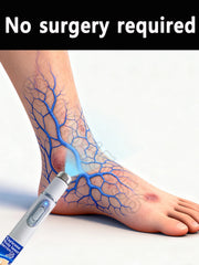 Varicose Vein  Remover